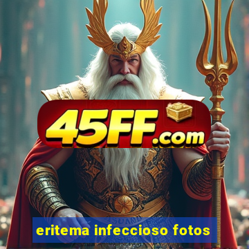 eritema infeccioso fotos